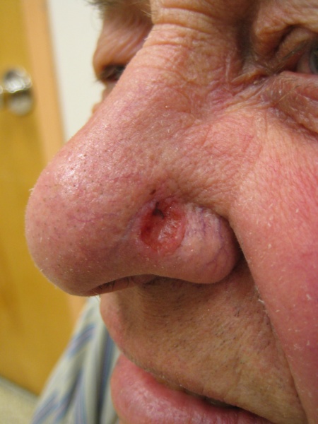 File:Basal cell carcinoma2.jpg