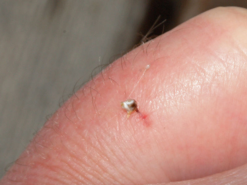 File:Bee sting 2.jpg