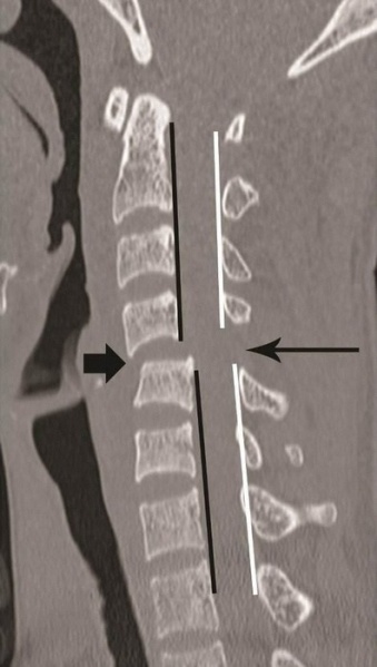 File:Bilateral Facet Dislocation.jpg