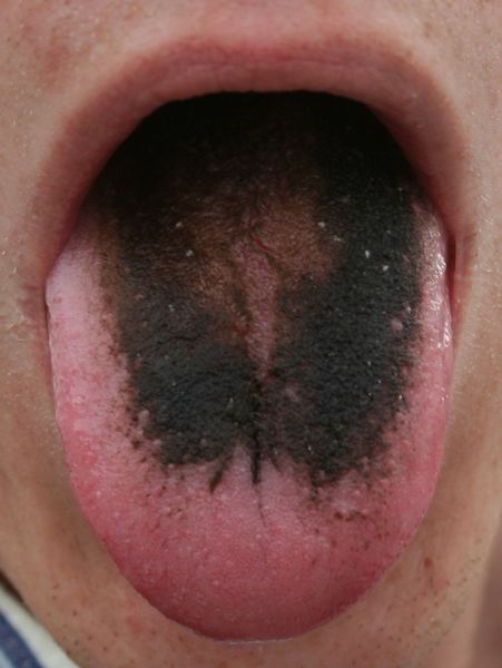 File:Black hairy tongue.jpg