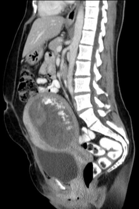 Molar pregnancy - WikEM