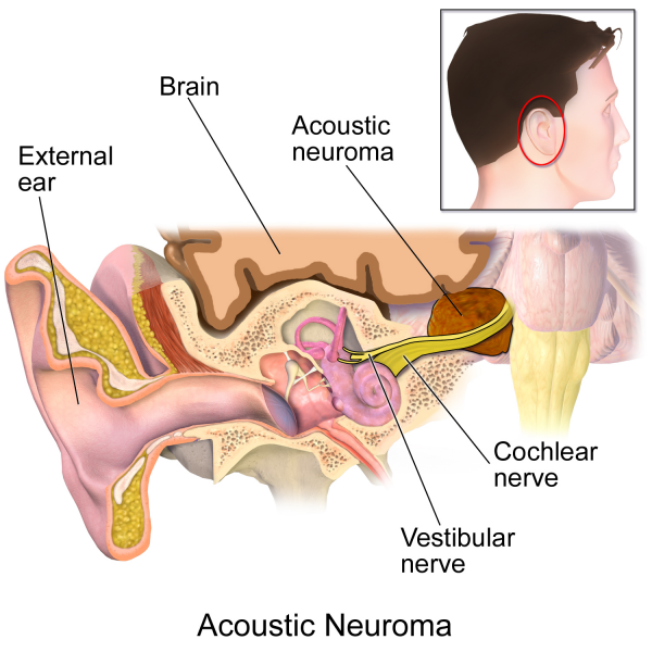 File:Blausen 0009 AcousticNeuroma.png