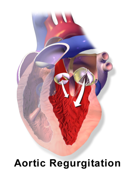 File:Blausen 0041 AorticValve Regurgitation.png