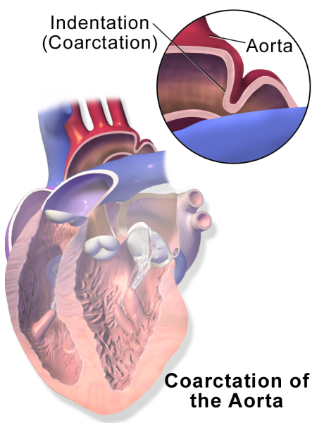 File:Blausen 0243 CoarctationofAorta CloseUp.png