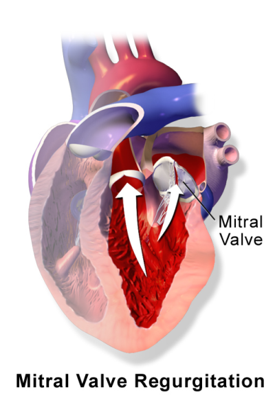 File:Blausen 0645 MitralValve Regurgitation.png