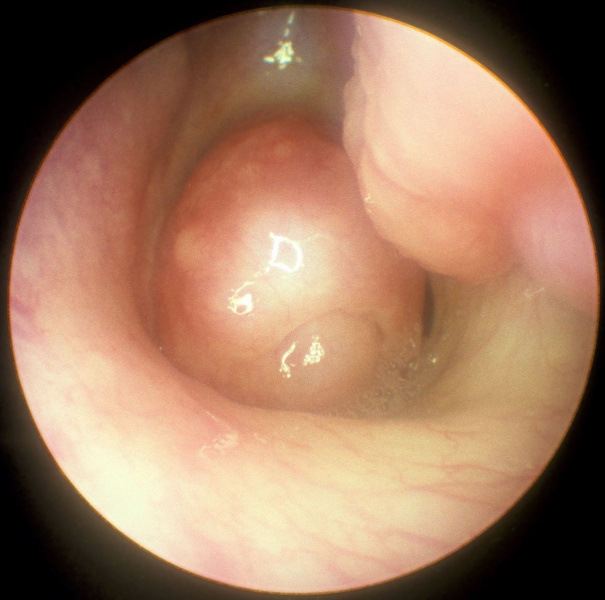 File:CHOANAL POLYP PerfectlyClear.jpg