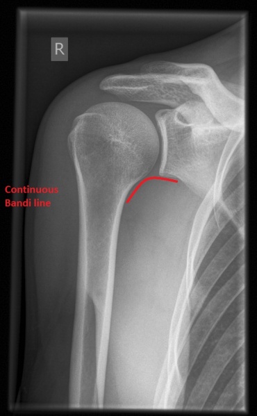 File:CR. shoulder x-ray, a.p..jpg