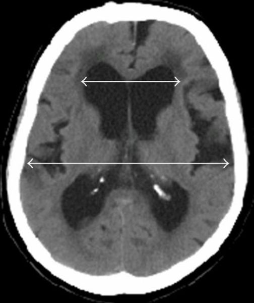 File:CT of Evan's index.jpg