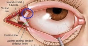 Canthotomy anatomy.jpeg