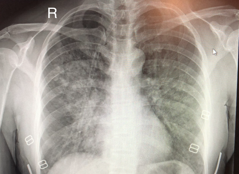 File:Chest XR of HAPE.png