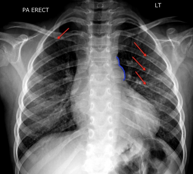 File:Coarctation CXR.jpg