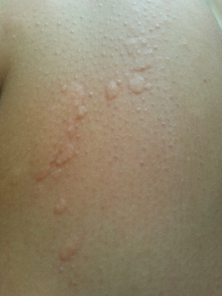File:Cold urticaria3.jpg