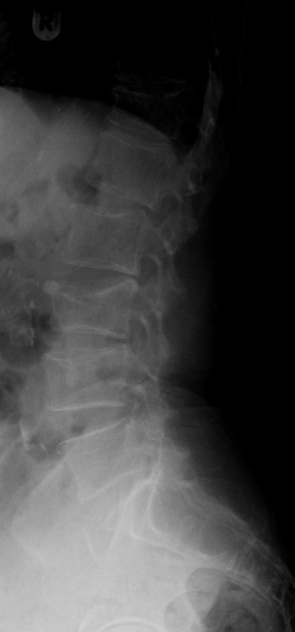 Thoracic and lumbar compression fractures WikEM