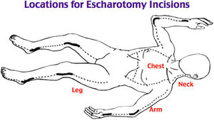 Content image - locations for escharotomy incisions.jpg