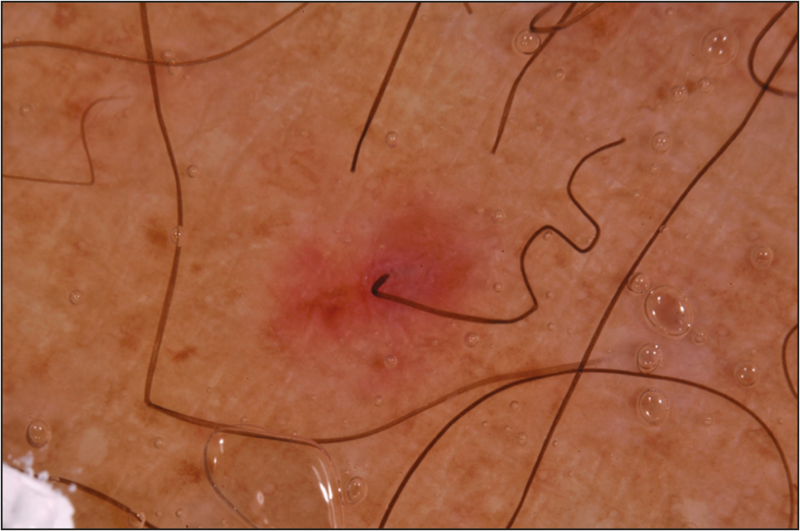 FileCorkscrew hair.png WikEM