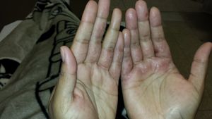Hand lesions coxsackie virus.