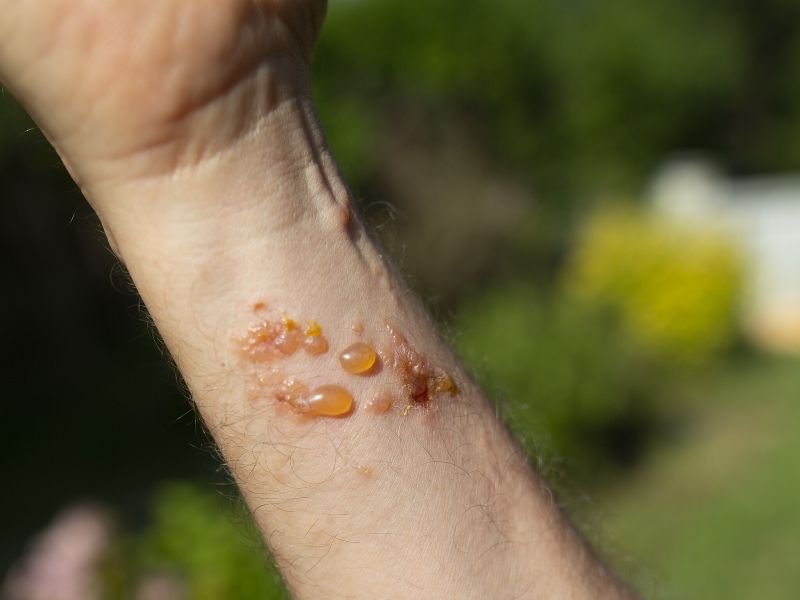 File:Dermite de contact.jpg