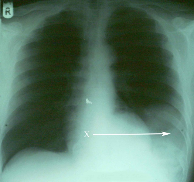 File:Diaphragmatic rupture spleen herniation.jpg