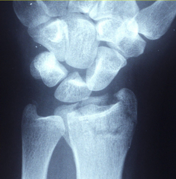 File:Displaced distal radius fracture.jpg