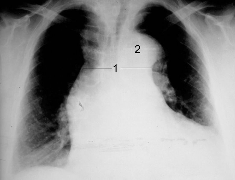 File:Dissection CXR.jpg