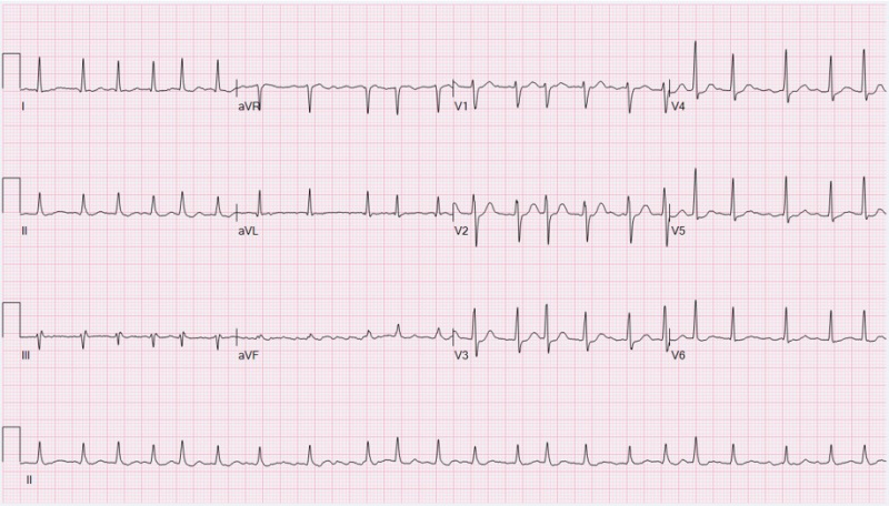 File:ECG Atrial Fibrillation.jpg