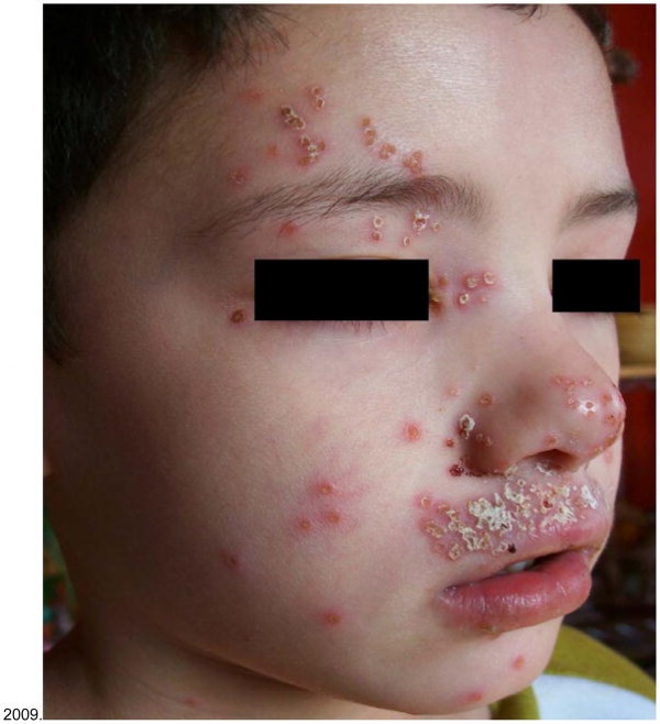 Eczema herpeticum WikEM