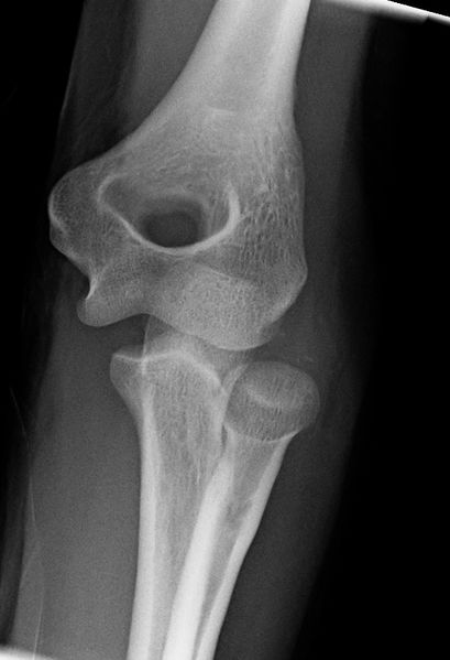 File:Elbow dislocation AP.jpg
