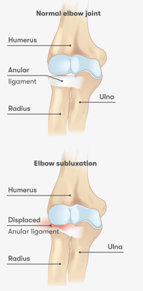 File:Elbow subluxation.png