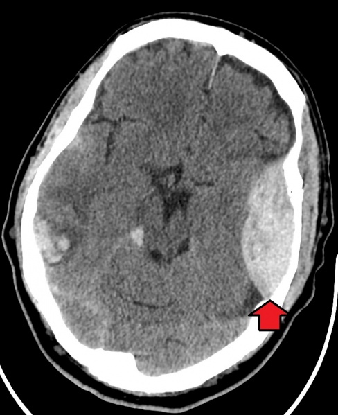 File:EpiduralHematoma.jpg