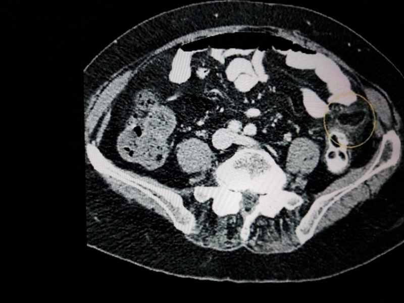 File:Epiploic Appendagitis .jpg