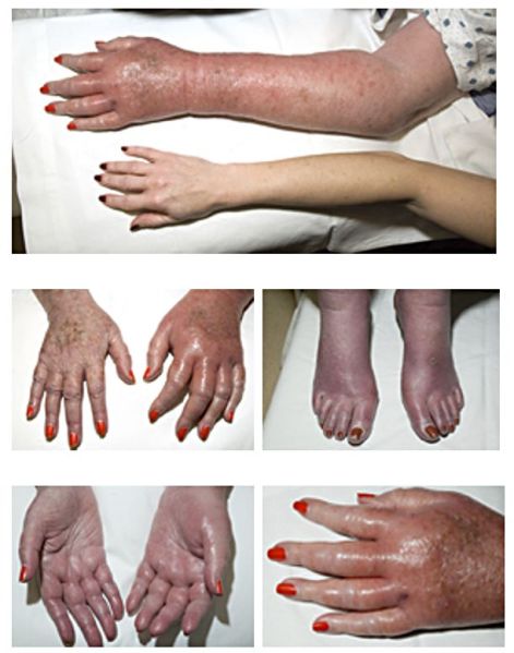 File:Erythromelalgia.jpg
