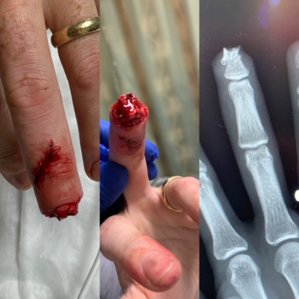File:Fingertip avulsion.JPG