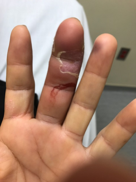 File:Flexor Tenosynovitis.JPG