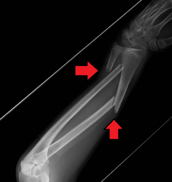 Radia ulna fracture WikEM