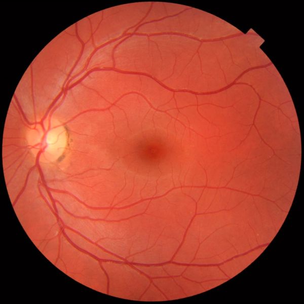 File:Fundus photograph of normal left eye.jpg