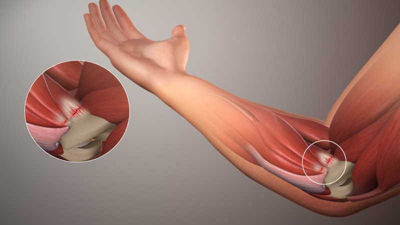 File:Golfers-Elbow SAG.jpg