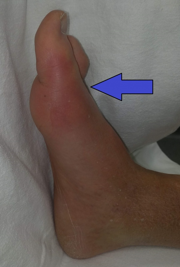 Gout and pseudogout WikEM