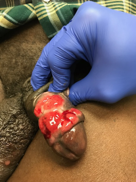 File:Granuloma Inguinale.JPG