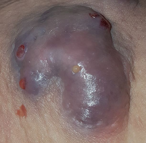 File:HS Hidradenitis Suppurativa.jpg