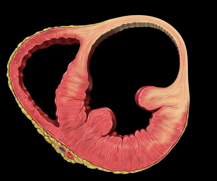 File:Heart left ventricular aneurysm sa.jpg