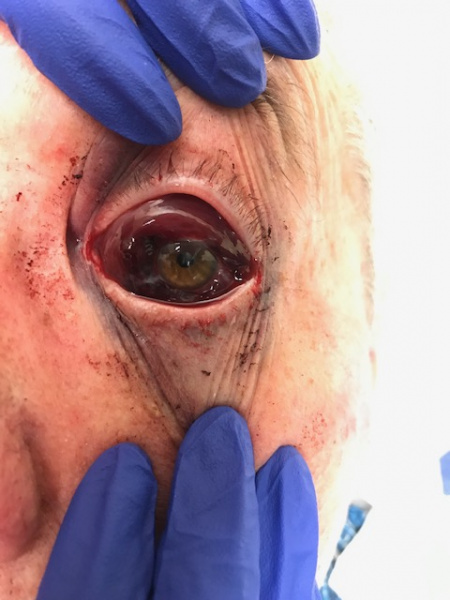 File:Hemorrhagic chemosis.jpeg