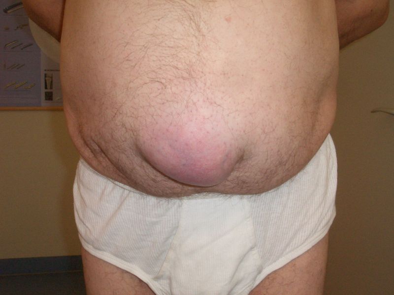 File:Hernia umilicalis.jpg
