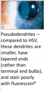 Herpes zoster ophthalmicus.jpg