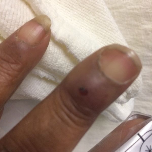 File:Herpetic Witlow 2015-01-06 04-30.jpg