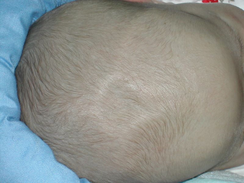 FileHuman anterior fontanelle 1 month dscn1449.jpg WikEM