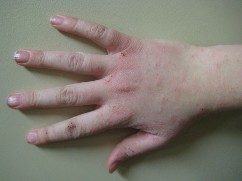 File:Human hand with dermatitis.jpg