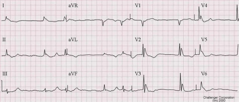 File:HypothermiaECG.jpg