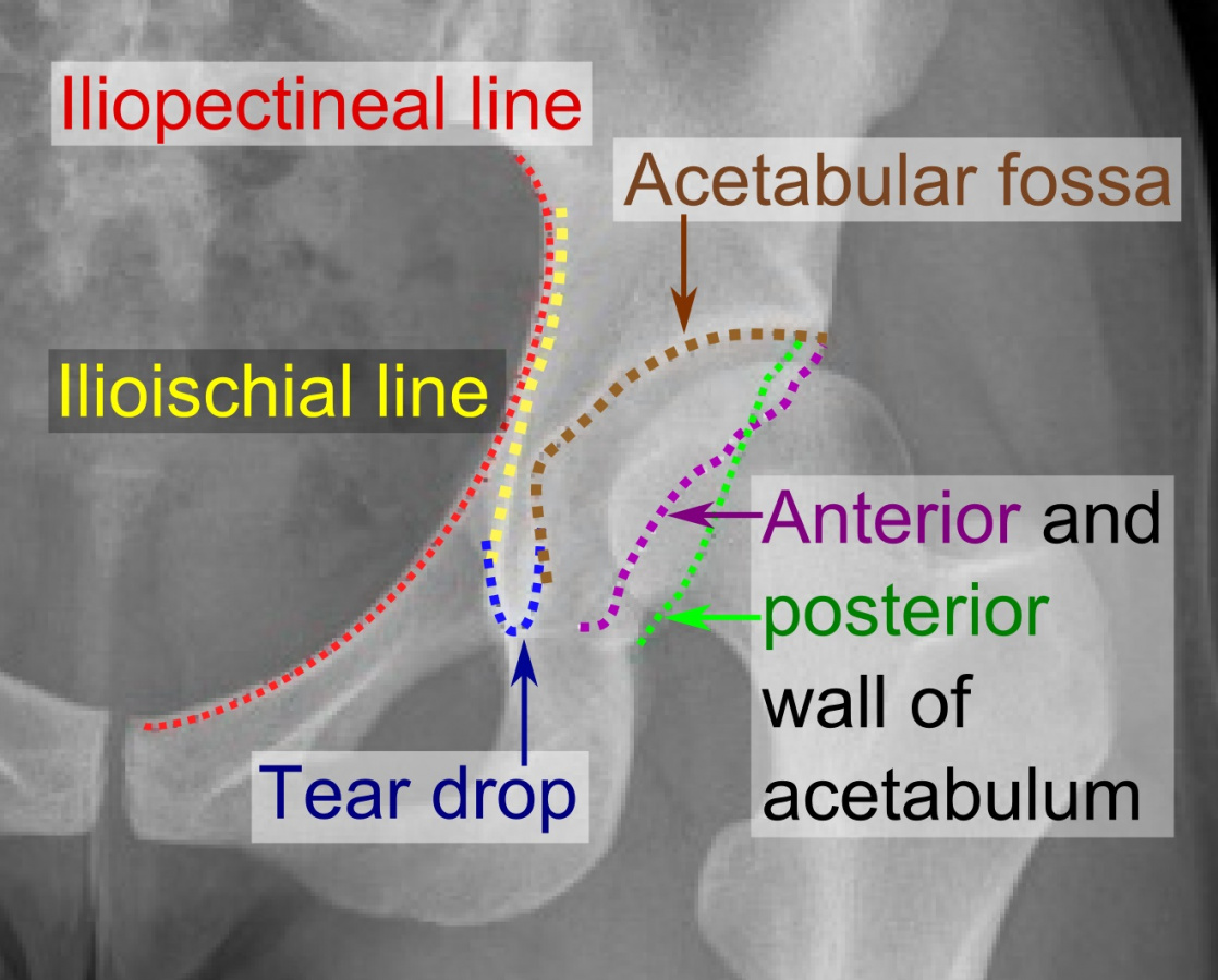 FileIliopectineal line, ilioischial line, tear drop, acetabular fossa