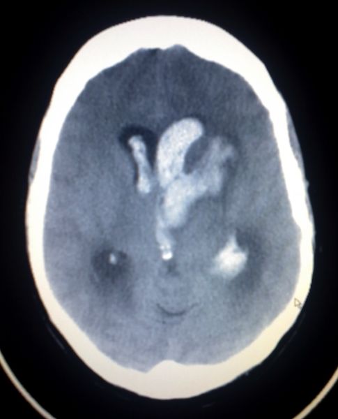 File:Intracerebral heamorrage.jpg