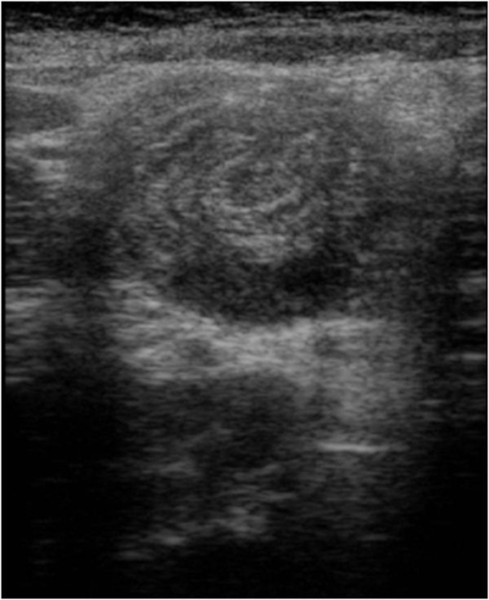 File:Intussusception 2.png
